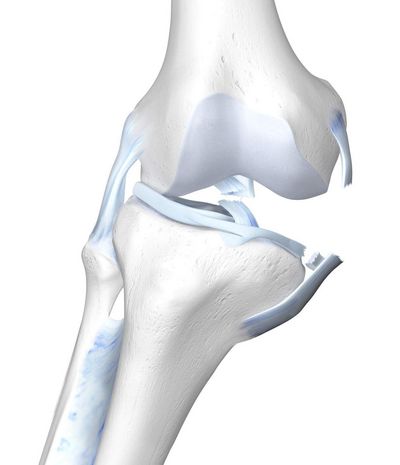 不幸なトライアドの膝の解剖図. 「Unhappy Triad」とは「不幸なトライアド（三人組）」のような意味で、この膝の怪我もそうです。膝関節の不幸な怪我の連鎖です。内靭帯、半月板（関節の軟骨片）、十字靭帯が損傷しています。複合損傷は通常、膝がねじれたときに発生します。